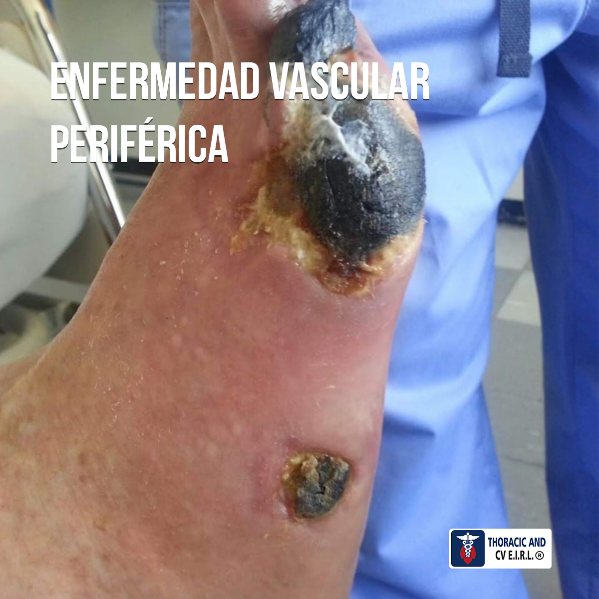 https://ctavsperu.com/wp-content/uploads/2019/11/enfermedad-vascular-periferica.jpg